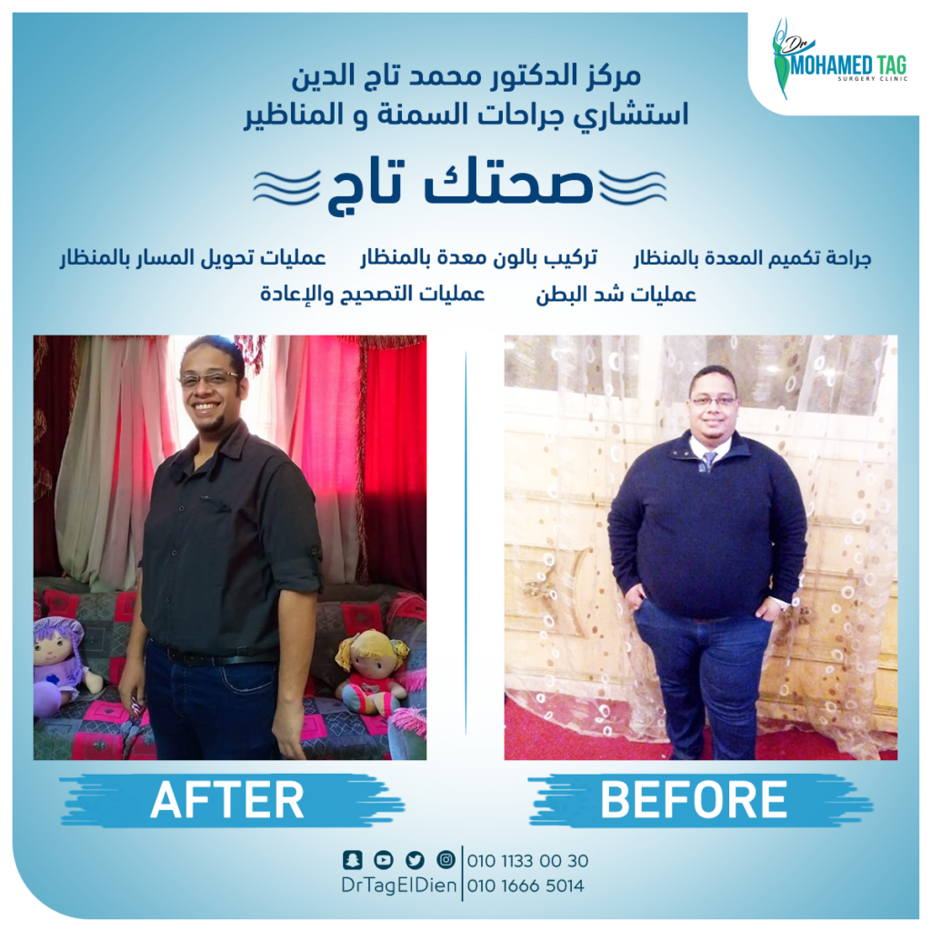 أحدث جراحات السمنة