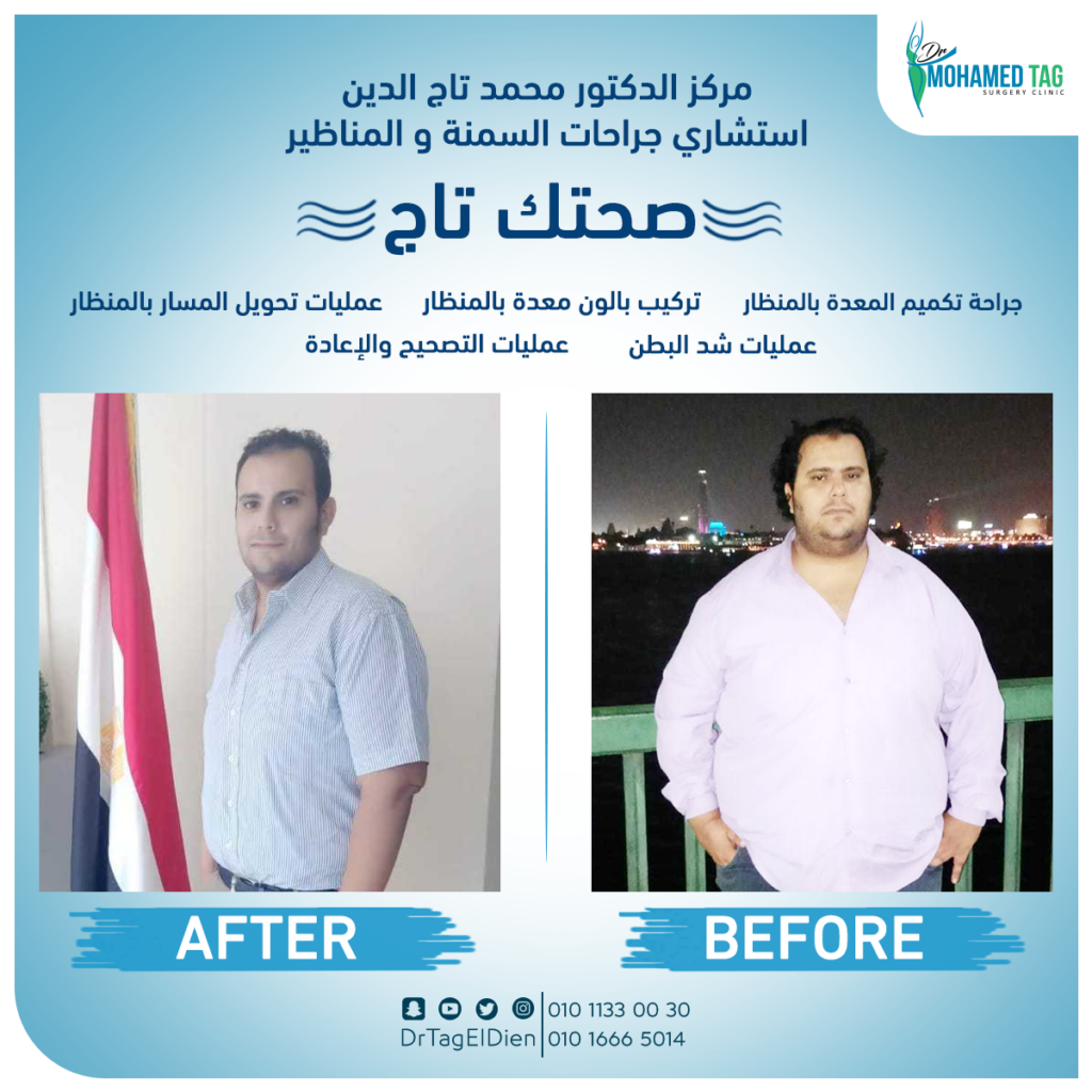 نجاح و فعالية عملية تحويل مسار المعدة