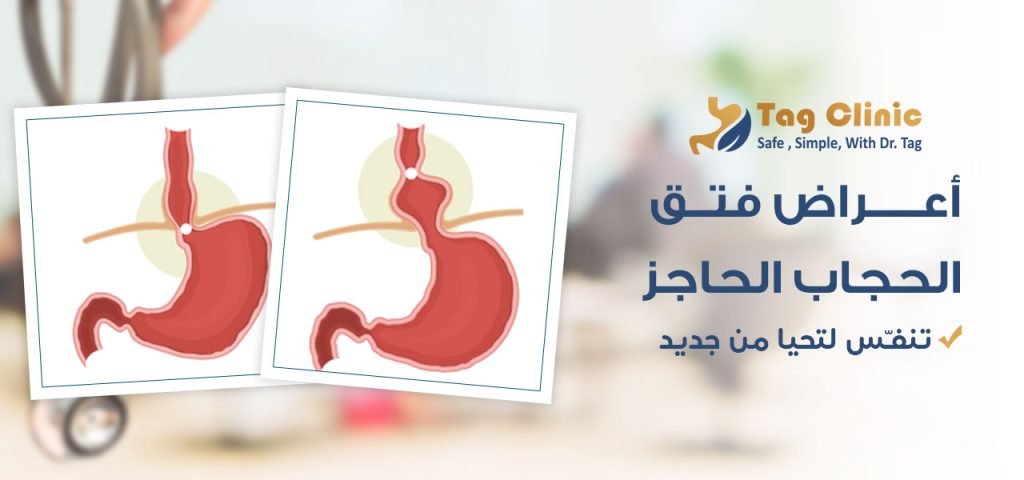 أعراض فتق الحجاب الحاجز