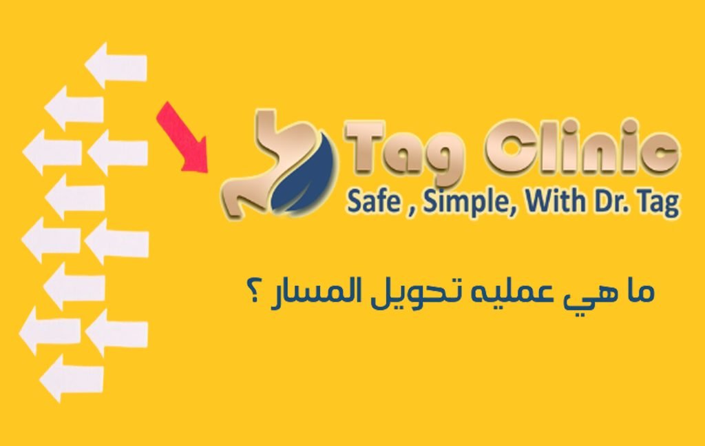 تحويل مسار المعدة