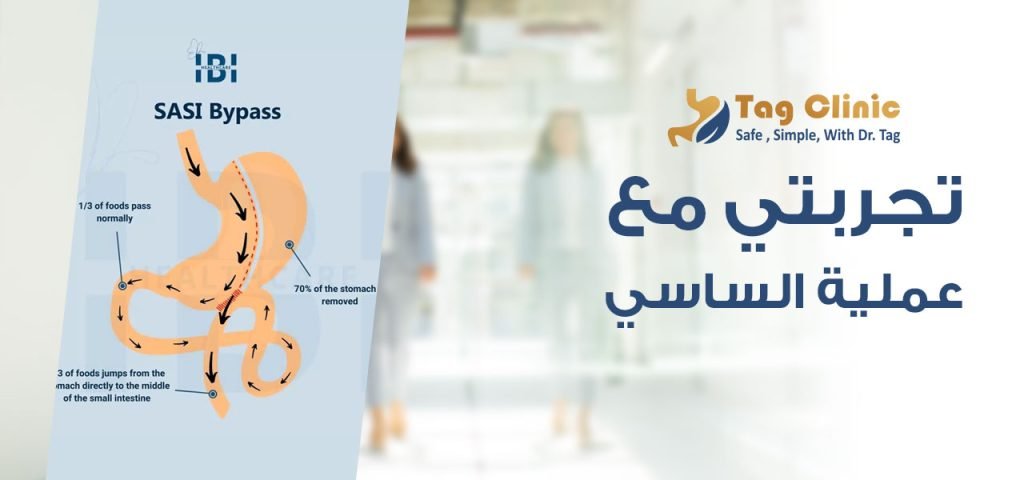 تجربتي مع عملية الساسي