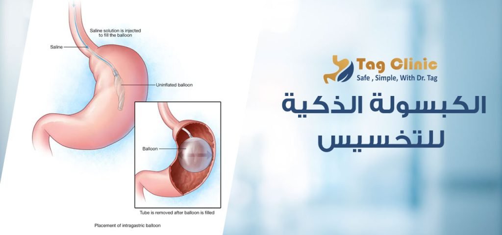 الكبسولة الذكية للتخسيس