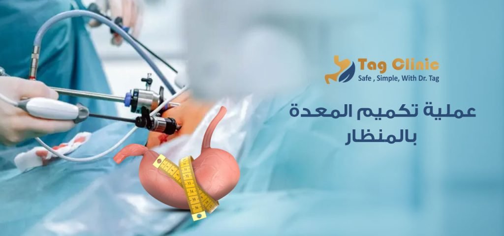 عملية تكميم المعدة بالمنظار